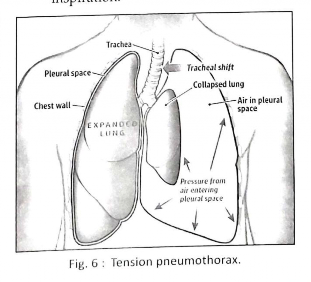 Pneumothorax BAMS Studies