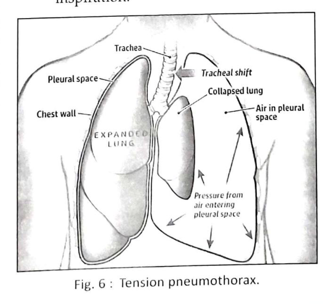 Pneumothorax BAMS Studies